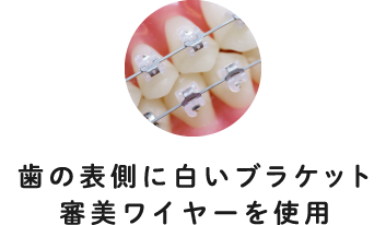 歯の表側に⽩いブラケット審美ワイヤーを使用